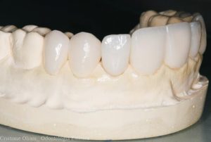 Lentes de Contato Dental